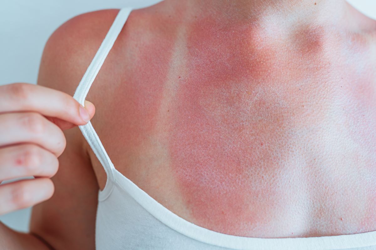 Sonnenbrand in Friesland vermeiden: Schützen, erkennen und r